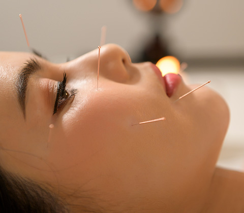 a woman laid down with acupuncture needles in her face