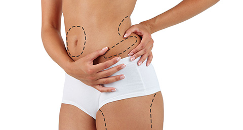a dotted line on a woman's body showing the areas for a liposuction treatment to be applied