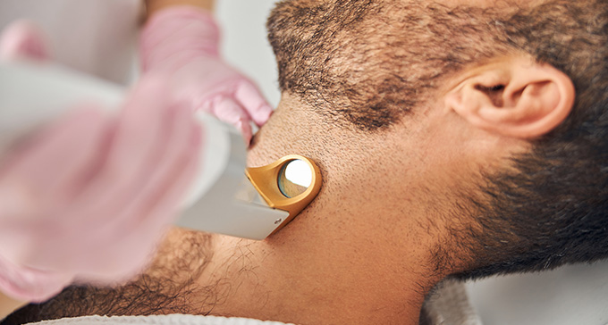 a bearded man undergoing a hair removal procedure on his nech and beard area