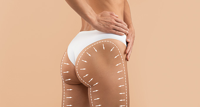 the buttocks of a woman after a successful anti-cellulite treatment