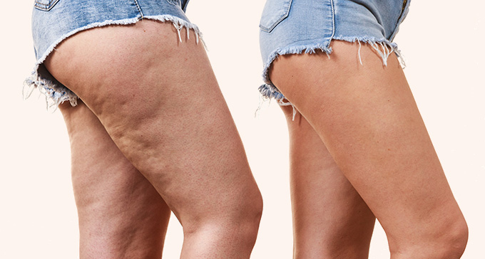the before and after from an anti-cellulite treatment of a woman's legs