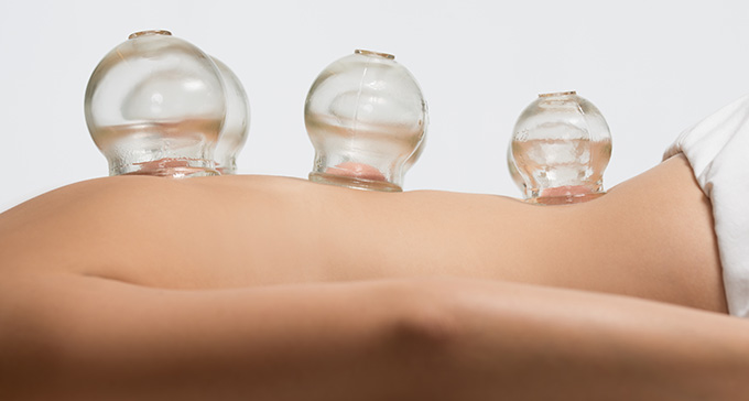 a person with wet cupping vacuum cups on their back